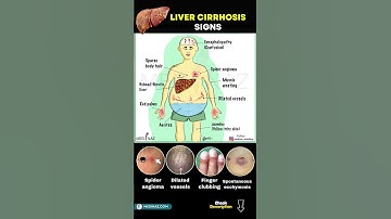 Liver Cirrhosis WARNING Signs You Shouldn