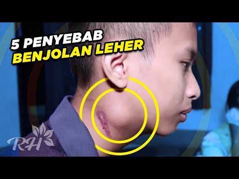 Sakit kepala secara umum merupakan suatu tanda bahwa ada yang tidak beres dengan tubuh kita. Namun s. 