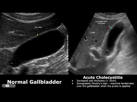 Image of Gallbladder Ultrasound Normal Vs Acute Cholecystitis 