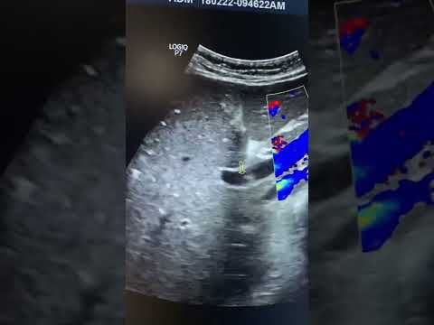 Portal vein thrombus ultrasound