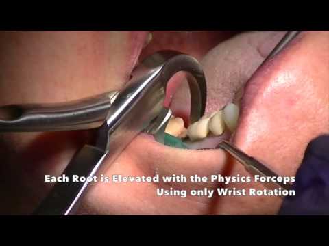 Lower Molar Extraction, Sectioned, Physics Forceps &amp; OsteoGen Plug Graft