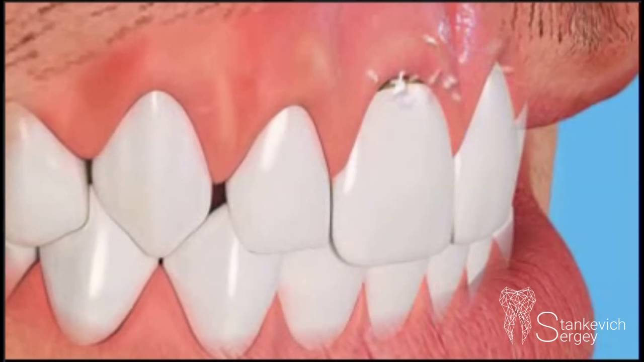 What is a clinoid defect of the hard tooth tissue?