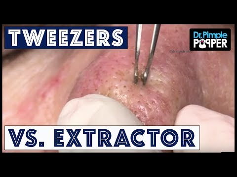 Dr Pimple Popper Blackhead SHOWDOWN: The Extractor Vs. The Tweezers