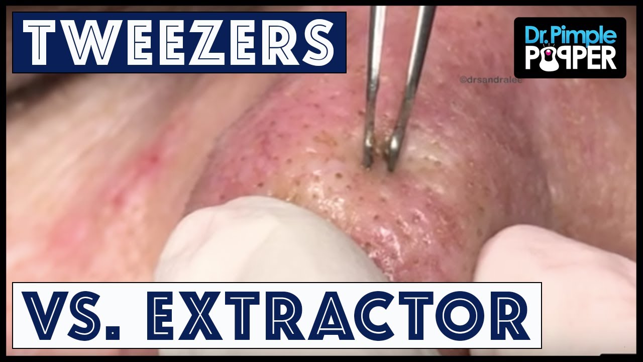 Video: Dr. Pimple Popper Compares Extractor and Tweezer for Blackheads.