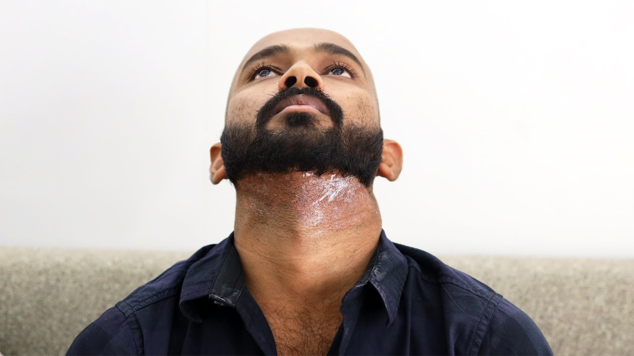 Corrective Hair Transplant Surgery New Roots Hair Clinic hairtransplantmumbai YouTube Corrective Hair Transplant Surgery New Roots Hair Clinic hairtransplantmumbai YouTube