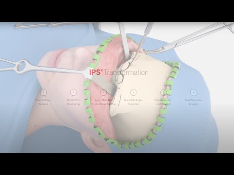 IPS® Transformation | Facial Feminization Surgery