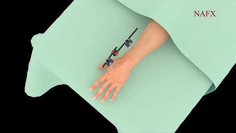 JETEF Wrist External Fixator