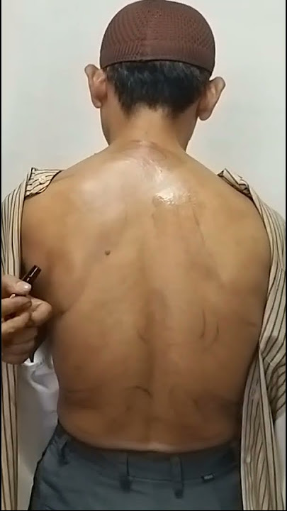 Emergency : Asma Sesak Napas # cara terapi Totok Punggung