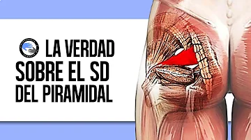 ¿Qué ocurre si no se trata el piriforme?