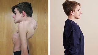 John Sarcona's Testimonial - Overcoming Severe Scoliosis and Kyphosis