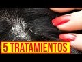 3 Tratamientos para el cabello: Cómo ELIMINAR LA CASPA!