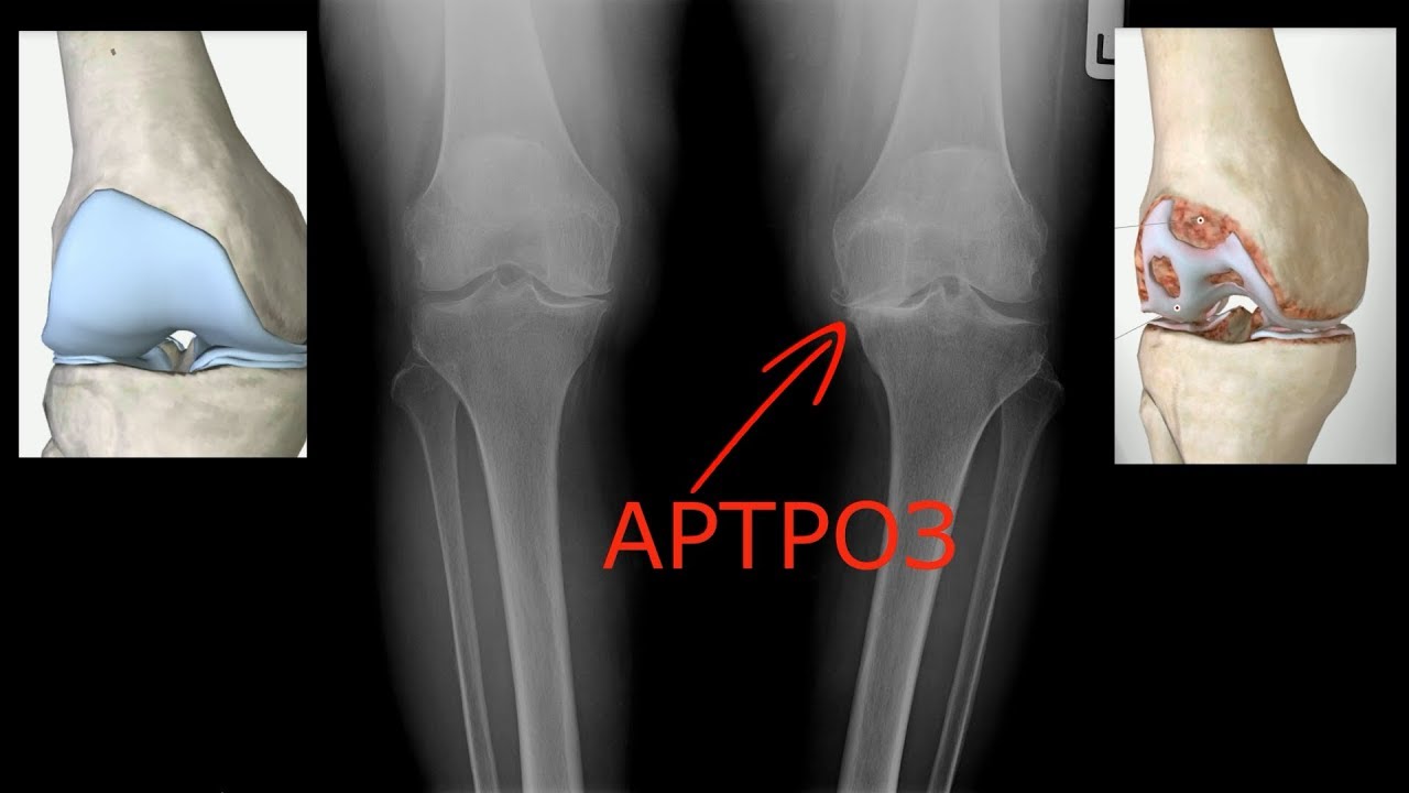 Артроз коленного сустава мениск. Деформирующий артроз 1 степени. Деформирующий остеопороз коленного сустава. Деформирующий артроз 2 степени. Деформ артроз коленного сустава.