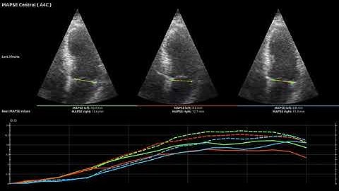 Tracking-based mitral annular plane systolic excursion (MAPSE) using deep learning in ultrasound