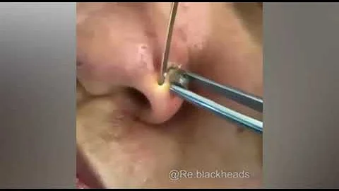 Top 15 viral pimple popping puss removal!! SOOO GR...