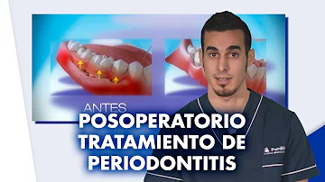 ¿Qué no se puede hacer después de un tratamiento periodontal?