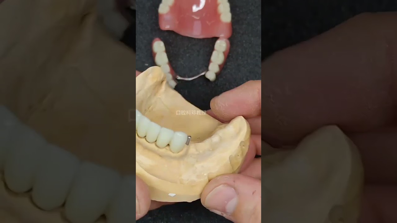 Fixed and removable denture 