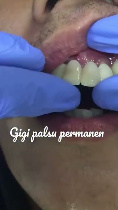 Gigi Palsu Permanen | Dental Bridge | Jembatan | Dokter Riesqi