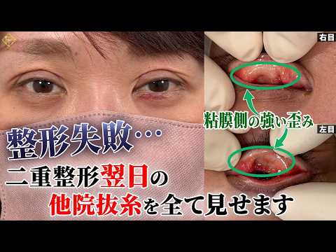 【整形失敗】二重埋没翌日の他院抜糸を解説！失敗しないために・失敗してしまった時のために必ず見てください。