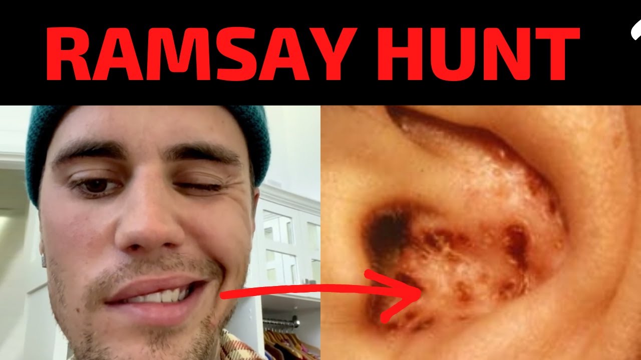 Ramsay Hunt Syndrome Explained Justin Bieber Ramsay Hunt Syndrome