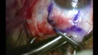 ניתוח הסרת פתריגיום עם שתל לחמית מודבק בדבק - פרופ אור קיזרמן Pterygium surgery with glue