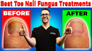 Best Toe Nail Fungus Treatments [Onychomycosis Remedies]