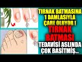 Tırnak Batmasını Doktora Gitmeden Tedavi Eden Yöntem Meğer Bu Kadar Kolaymış !