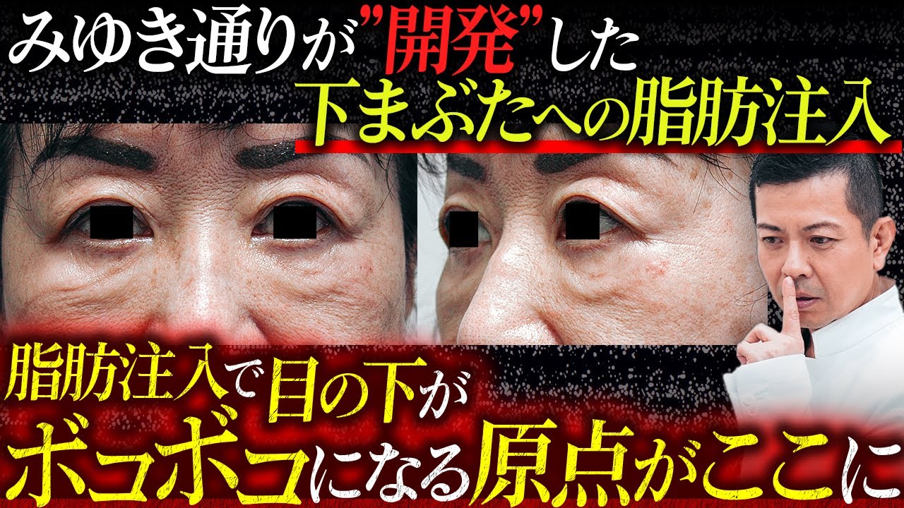 【注意喚起】取り返しのつかない危険な目の下への脂肪注入。ぼこぼこで悲しむ患者様をこれ以上増やさないための解剖学的な真実をお話しします。【クマ治療】