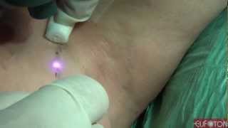 Phlebology Reticular Telangectasias - Lasemar800 Eufoton
