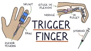 Understanding Trigger Finger (Stenosing Tenosynovitis) Resimi