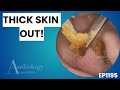 Extreme Ear Wax Removal | Thick Skin & Possible Keratosis Obturans- EP1195