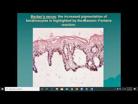 Lecture-16: Benign Melanocytic Naevi