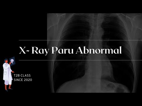 X Ray paru abnormal