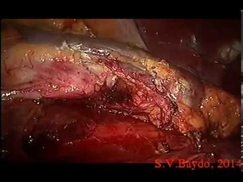 Laparoscopic Anatomical Upper Pole Partial Nephrectomy