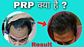 PRP kya hota hai || What is PRP hair treatment