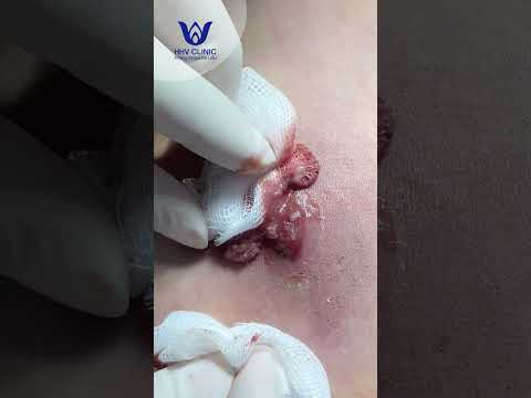 Nặn mụn u nang bã ở Lưng.