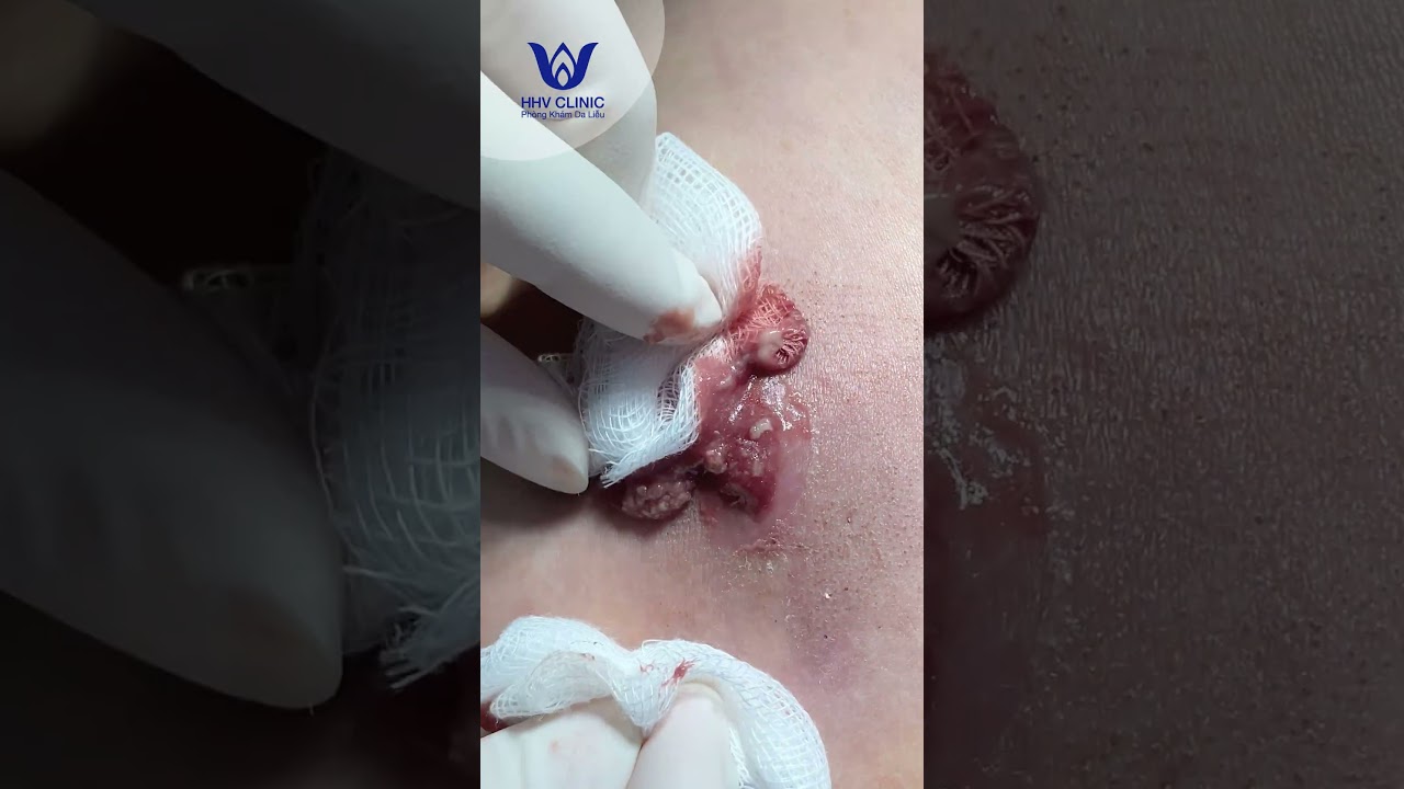 Nặn mụn u nang bã ở Lưng.