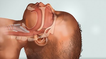 Laryngospasm by H. Leahy, J. Wang | OPENPediatrics
