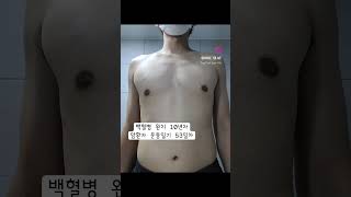 #팔굽혀펴기 #오운완 #운동인증 #일상 #백혈병 #동기부여 #암환자 #암환자브이로그 #암환자운동 #운동챌린지 #운동일기 #푸쉬업챌린지 #푸쉬업 #푸시업