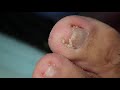 Ep_3331 Big ingrown toenail removal 👣 มันปักอยู่ข้างหน้าครับ 😷 (clip from Thailand)