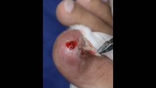 Huge ingrown toenail