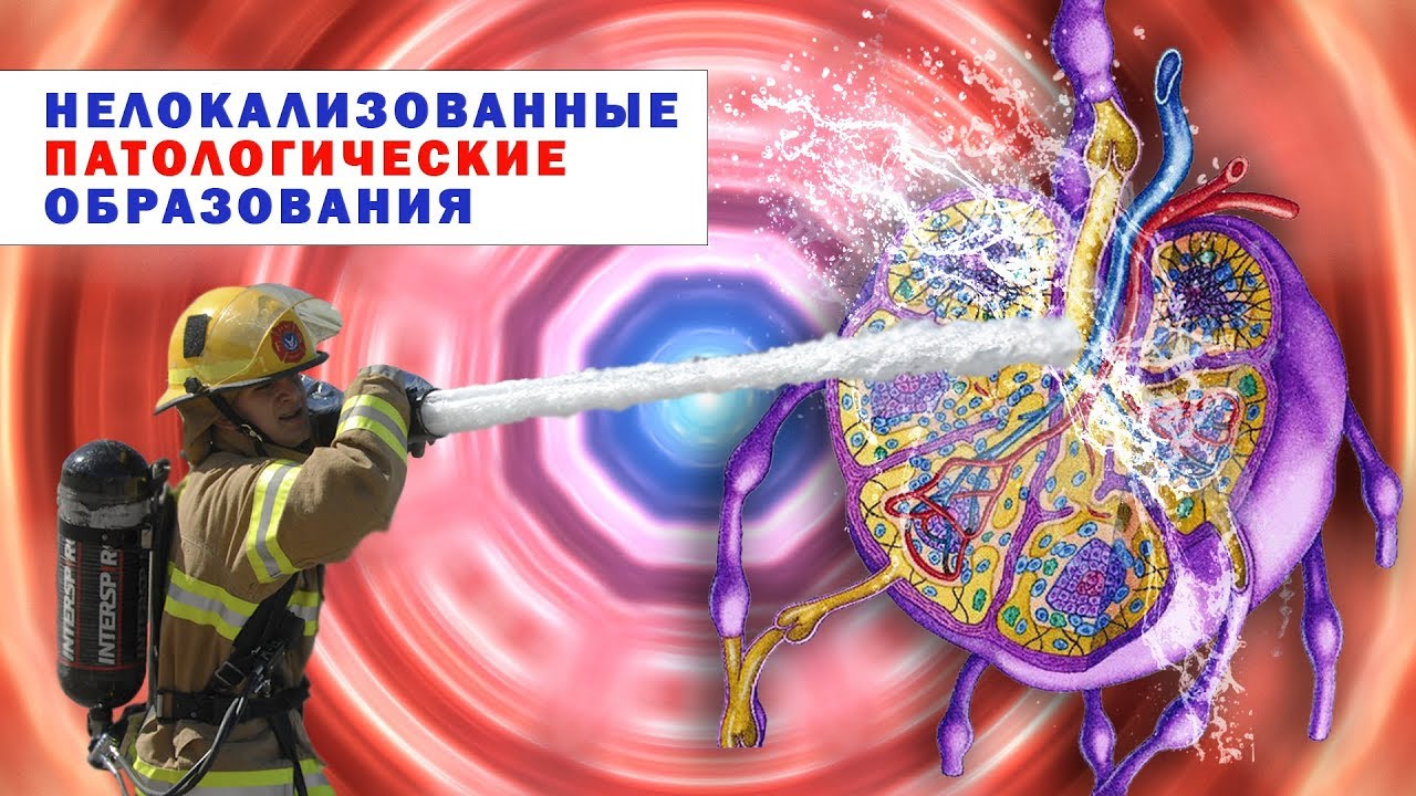 Лечение рака. Нелокализованные патологические образования. Практика по ...