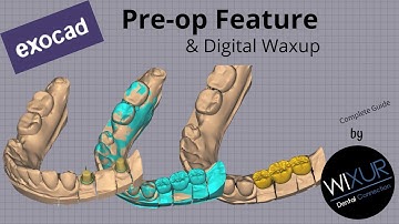 exocad Pre-op Feature (Digital Waxup)