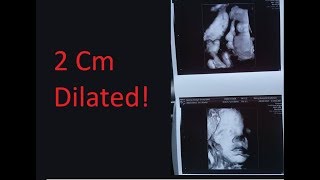 2cm Dilated, 3d ultrasound