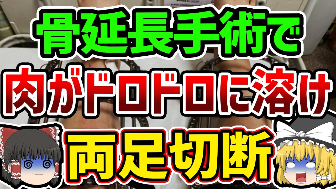 【ゆっくり解説】身長を伸ばすはずが両足を失う事態に…骨延長手術で地獄の苦しみ