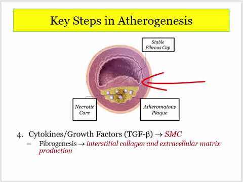 12DaysinMarch, ASHD#1: Atherogenesis for the USMLE Step One Exam