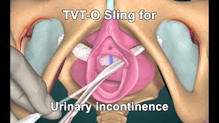 TVTO or TVT Sling for stress urinary incontinence | Treatment for urinary incontinence in female