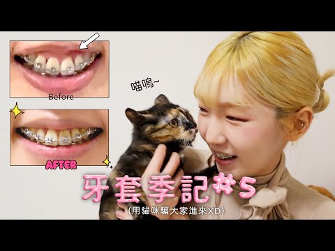 牙套季記 #5 🦷 笑起來變更漂亮了✨ 這三個月雖然改變不大 不過發現變漂亮關鍵就在於...|白 @xx.bb.ai