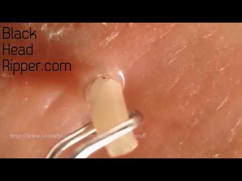 Facial Pore Extraction 19