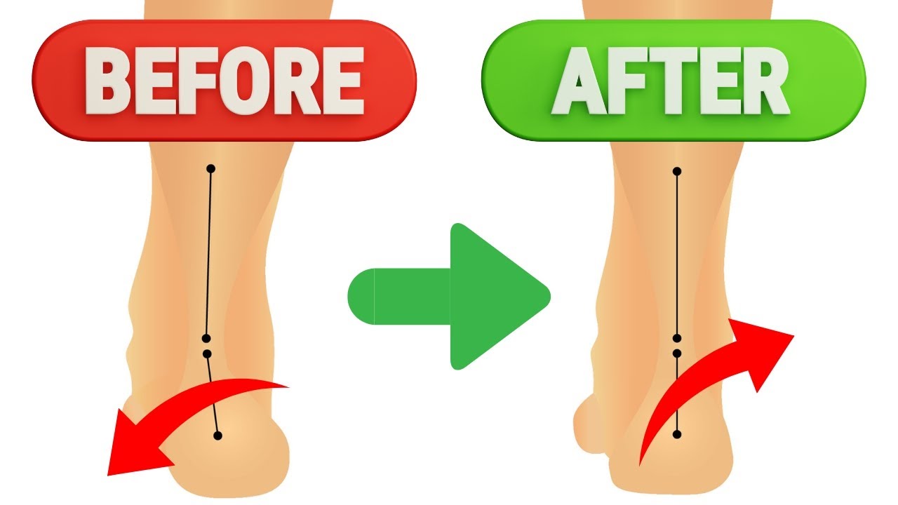 【扁平足（オーバープロネーション）の改善には股関節内旋の獲得がキーポイント】扁平足・足のアーチ低下には「股関節内旋」の獲得が重大なカギになる理由！扁平足に対する統合的な運動療法・ピラティス！