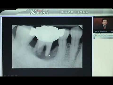 非手術~如何治牙周?- DR. 李德孚